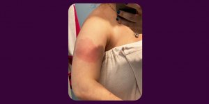 skin-reaction-covid-19-vaccine-te-main-210305_a4de0c322650695ab3b9b3916a05491c.fit-760w.jpg
