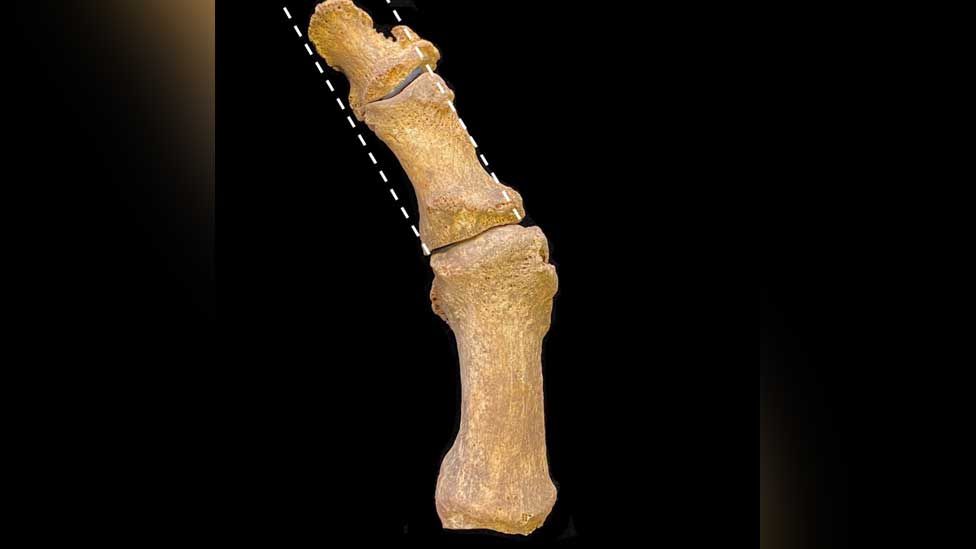 Excavated medieval foot bones with bunion Excavated medieval foot bones with bunion